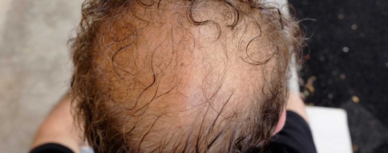 Alopecia formula magistral